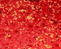 Photomicrograph of vacuoles—microscopic holes in the grey matter—gives the brain of BSE-affected cows a sponge-like appearance when tissue sections are examined in the lab.
