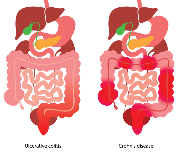 colitis crohns